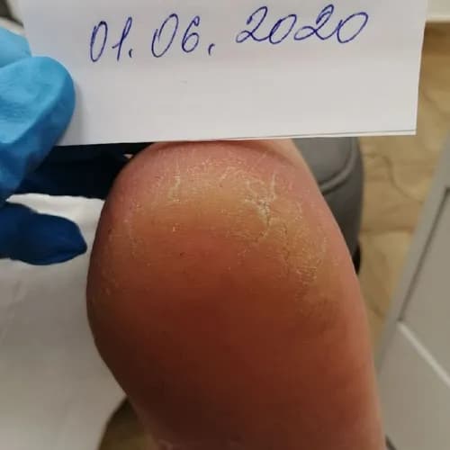 Восстановление пяток в уютной обстановке