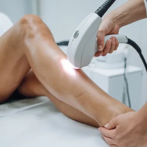 Laser na nogi: depilacja laserowa goleni