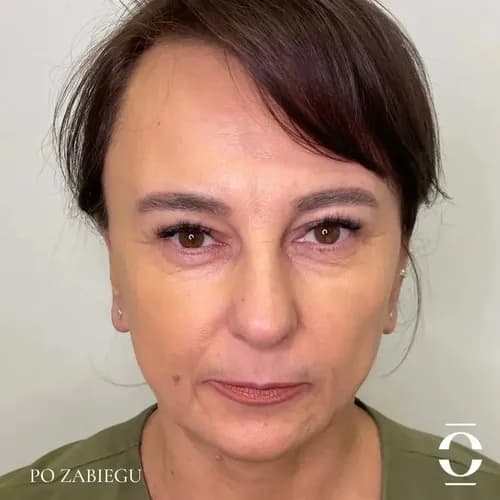 Gładka skóra na lata – laserowa depilacja klatki piersiowej