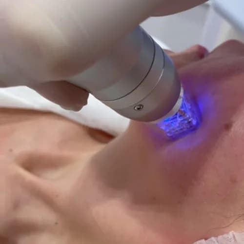 Na zawsze gładka twarz dzięki depilacji laserowej