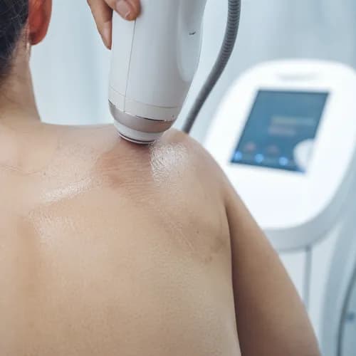 Laserowe usuwanie owłosienia z pleców - trwale wolne od włosów