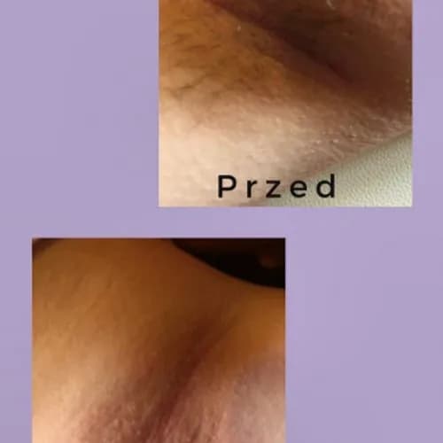 Пахви без волосків - цукрова депіляція