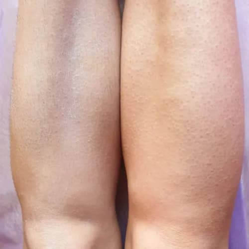 Шугаринг гомілки - ідеальна гладкість для ваших ніг