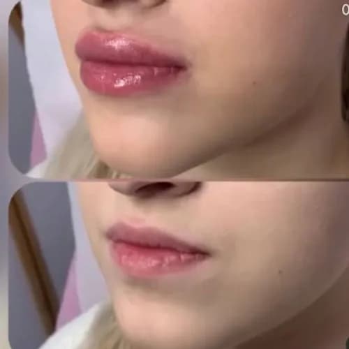 Естественное увеличение губ от меня