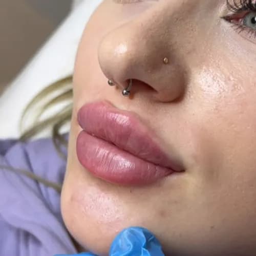 Профессиональное увеличение губ "Индивидуально для тебя"