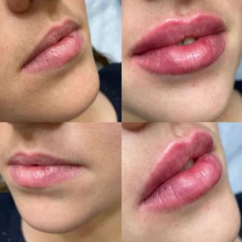 Iniekcyjna plastyka ust: wyrazistość i naturalność