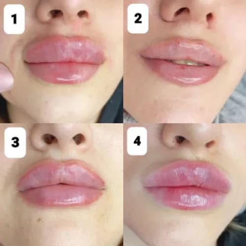 Увеличение губ "Мой фирменный стиль"