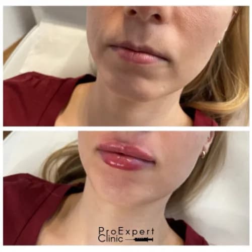 Powiększanie ust „Sekrety naturalnego piękna”