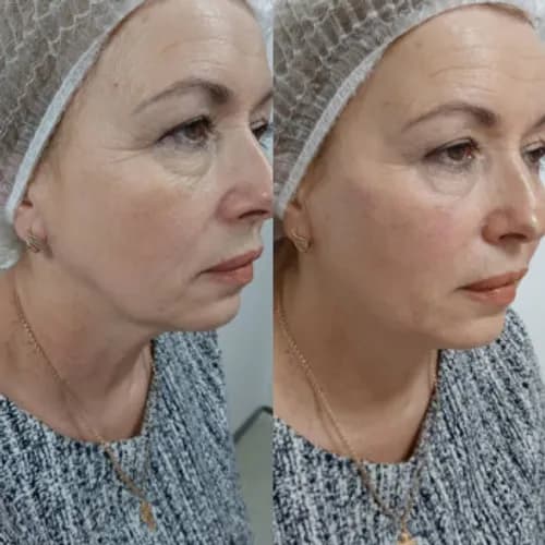 Омоложение ботоксом: научный подход к красоте
