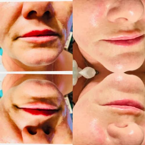 Botox na twarz - efekt bez ekscesów