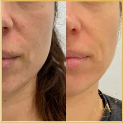 Skóra wolna od zmęczenia dzięki mezoterapii