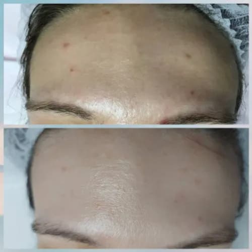 Aktywny zastrzyk młodości