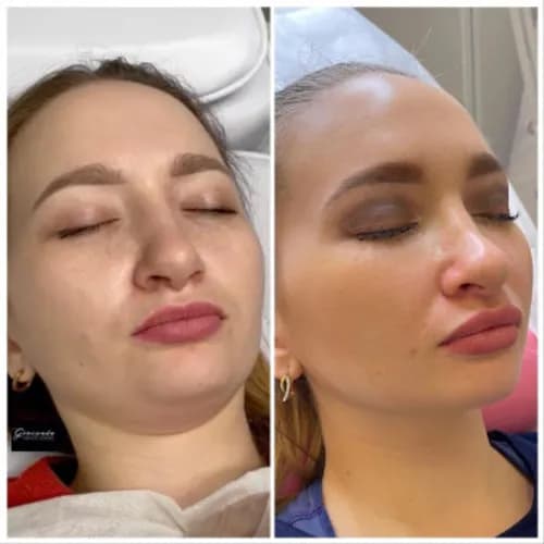 Мезотерапия для здорового сияния