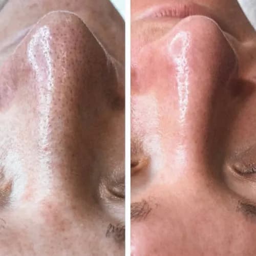 Czysta twarz dla Twojego sukcesu