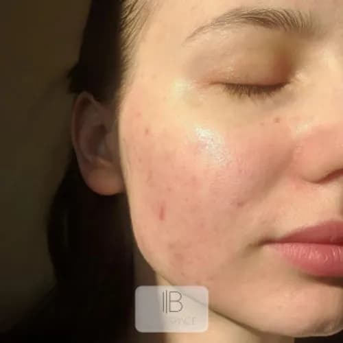 Глубокое очищение гальваникой для вашей кожи
