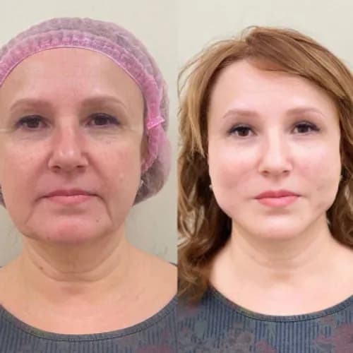 Reboot dla twarzy - oczyszczanie galwaniczne