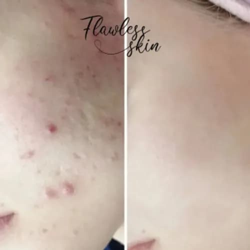 Peeling z kwasem salicylowym: idealna skóra bez stanów zapalnych