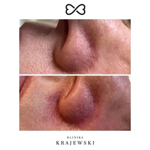 Żółty peeling retinolowy