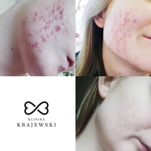 Żółty peeling retinolowy