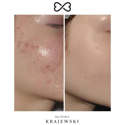 Żółty peeling retinolowy