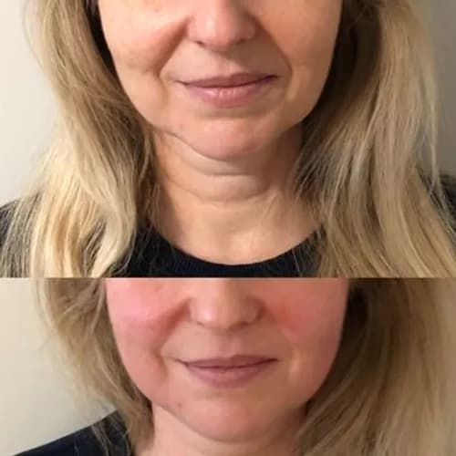 Скульптурный массаж для омоложения