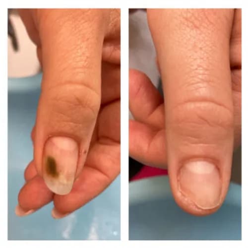 Эстетичное протезирование ногтевой пластины