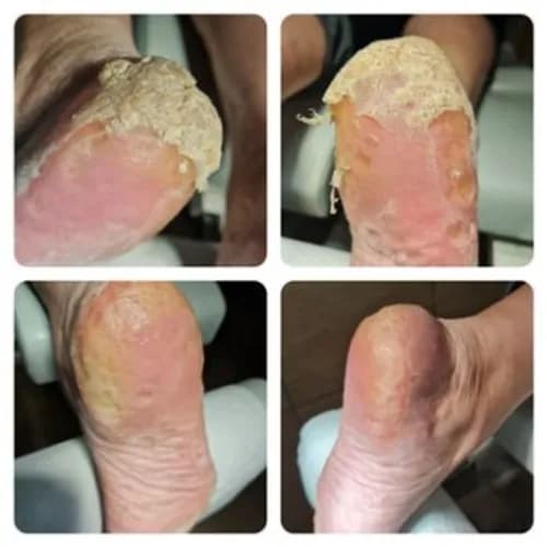 Usuwanie odcisków dla zdrowej i pięknej skóry