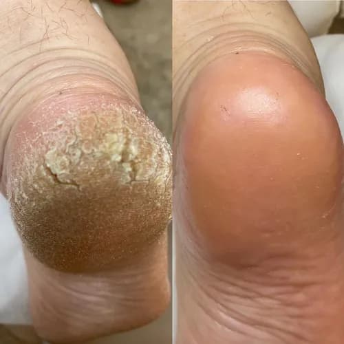 Usuwanie odcisków z pielęgnacją skóry