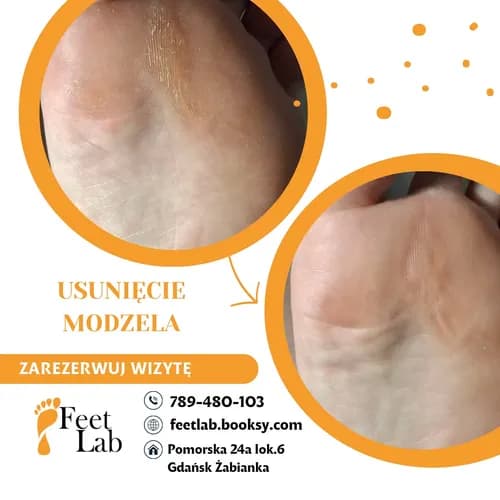Idealne pięty - profesjonalne usuwanie odcisków