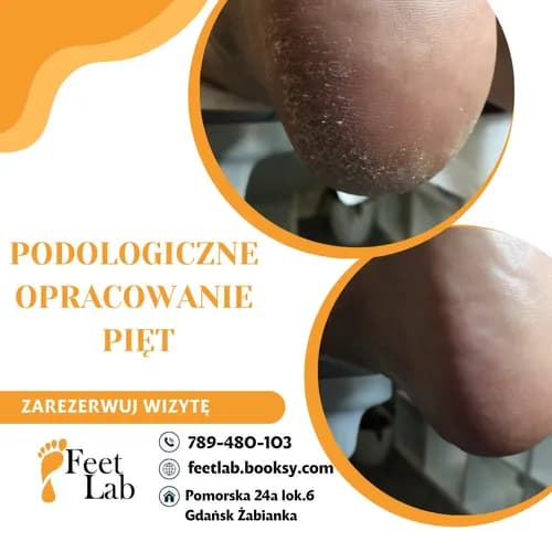 Idealne pięty - profesjonalne usuwanie odcisków