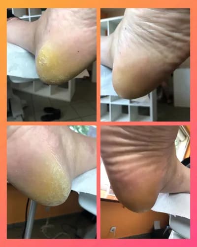 Idealne pięty - profesjonalne usuwanie odcisków