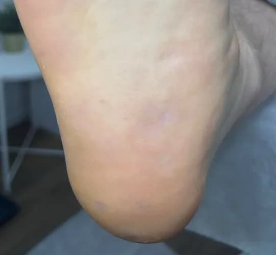 Usuwanie odcisków - piękno w każdym kroku