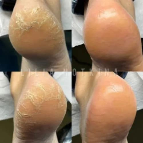 Usuwanie odcisków - komfort i pielęgnacja stóp.