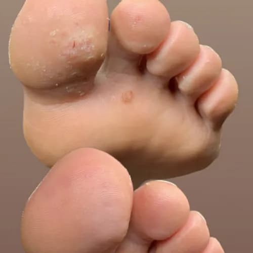 Zdrowa stopa - pozbądź się brodawek