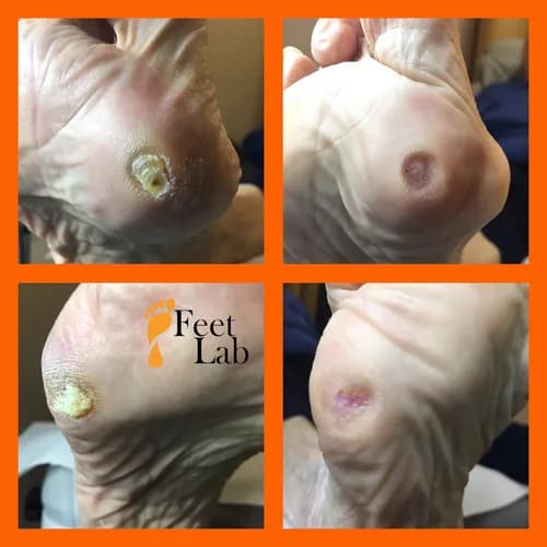 Profesjonalne leczenie brodawek stóp z troską o Ciebie