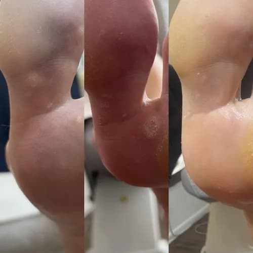 Профессиональный уход за стопой – лечение бородавок на высоком уровне