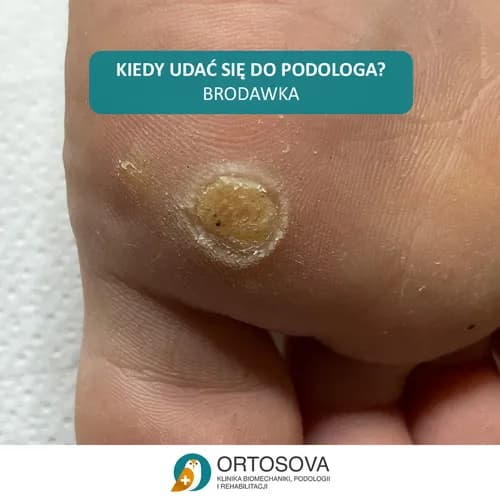 Наши специалисты – лечение бородавок на стопе с гарантией результата