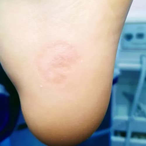 Fachowe leczenie brodawek stóp dla komfortu stóp