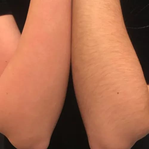 Depilacja cukrowa rąk: doskonałość skóry po jednej wizycie