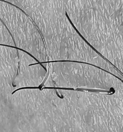 Деликатная эпиляция сахаром