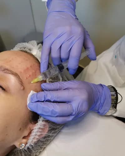 Profesjonalna mezoterapia dla promiennej skóry twarzy