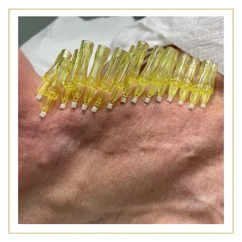 Iniekcyjne odmłodzenie twarzy. Skuteczna mezoterapia