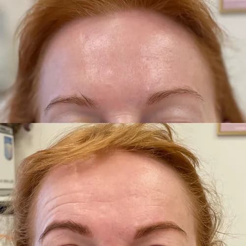 Przywrócenie młodości skóry przez mezoterapię