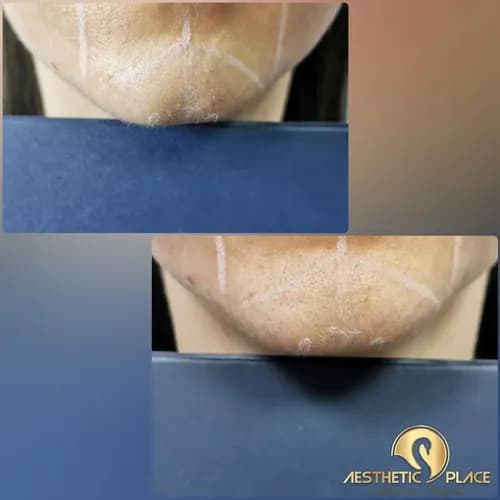 Profesjonalne zastrzyki piękna