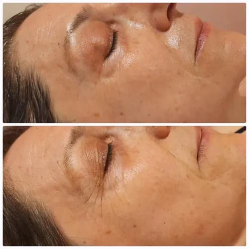 Odmłodzenie twarzy metodą mezoterapii