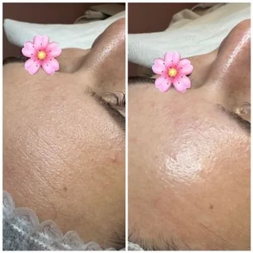 Mezoterapia twarzy, naturalna transformacja