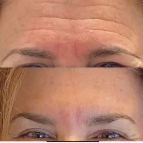 Mezoterapia dla nawilżenia i odżywienia skóry