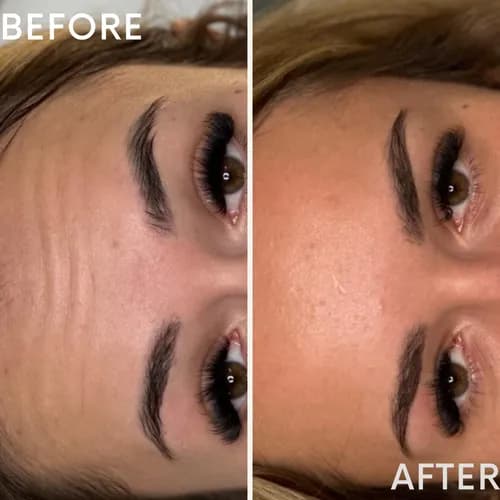 Iniekcyjna mezoterapia, młodość twojej skóry