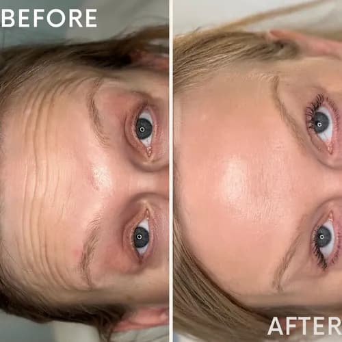 Iniekcyjna mezoterapia, młodość twojej skóry