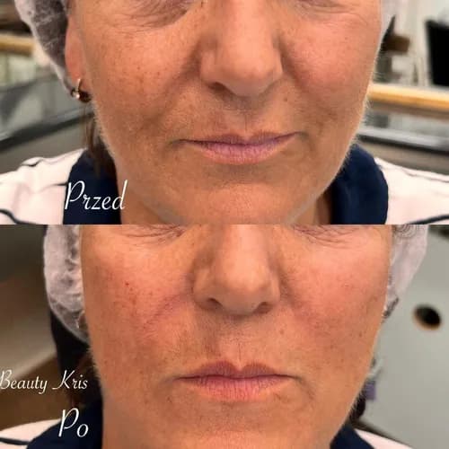 Mezoterapia twarzy, widoczny efekt po pierwszym zabiegu
